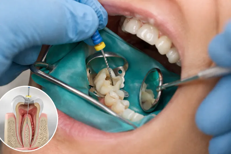 Root canal treatment explained step by step
